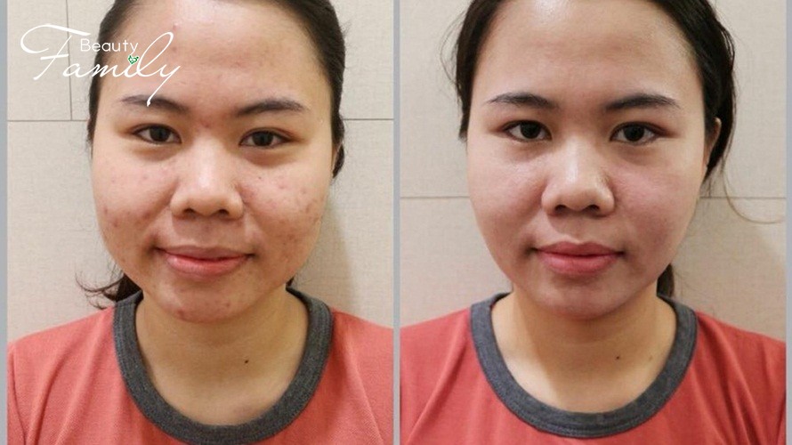Thanh lọc làn da sạch mịn với liệu trình thải độc tố chuẩn tại Yakson Beauty
