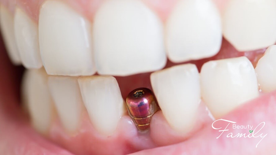Cấy Implant – phương pháp trồng răng tối ưu nhất hiện nay