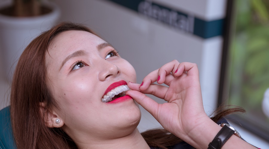 02 sai lầm cực lớn khiến quá trình niềng răng thất bại