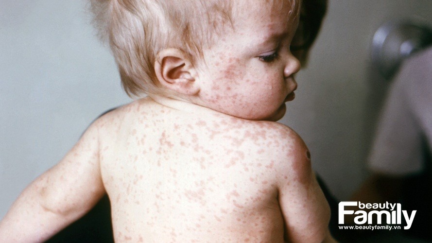 Biến chứng của bệnh sởi: đáng sợ hơn mẹ tưởng tượng