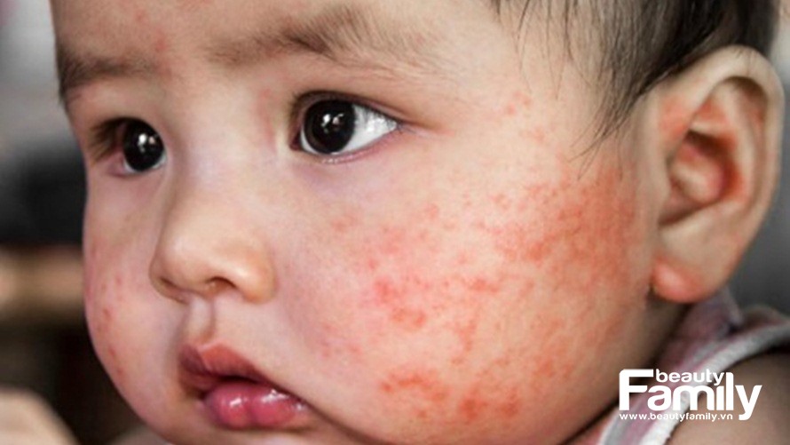 Chỉ tên một số căn bệnh ngoài da thưởng gặp ở trẻ nhỏ