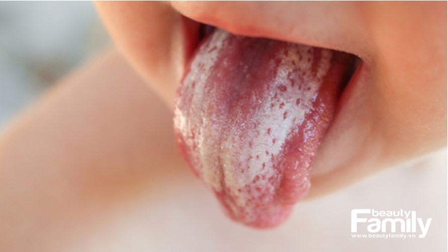 Chữa bệnh tưa lưỡi cho trẻ sơ sinh không còn là vấn đề nan giải
